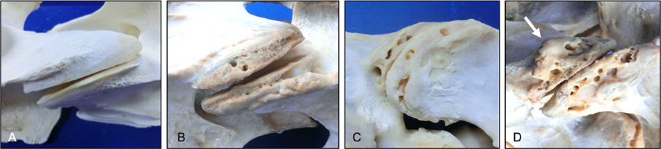 equine cervical articular process joints showing progressive increases in grades of osteoarthritis severity.