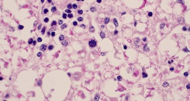 epm cyst