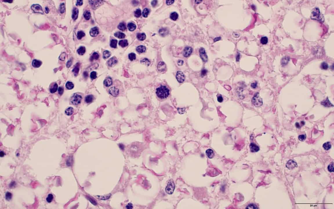 epm cyst
