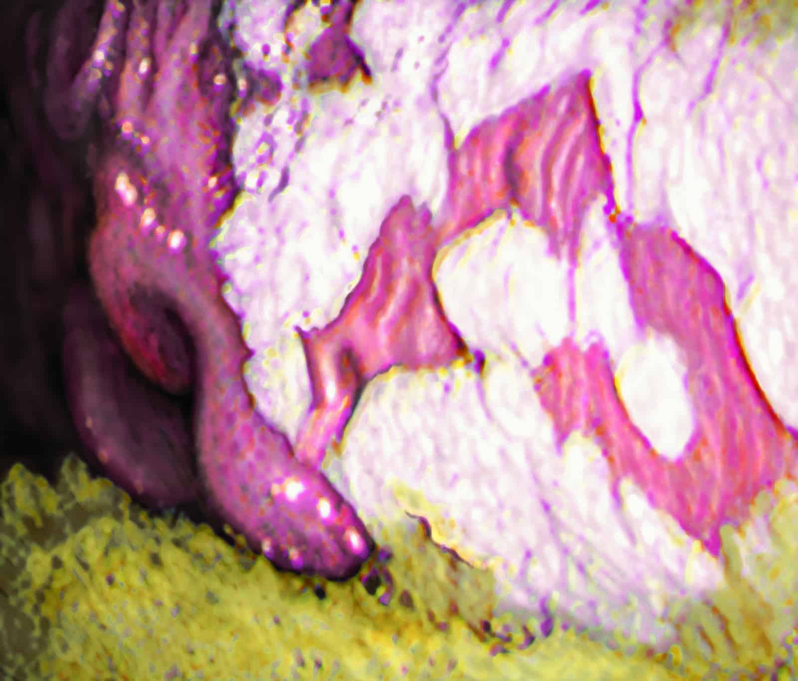 gastric ulcers